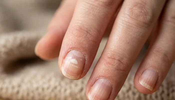 Close-up of fingernails showing signs of vitamin deficiency like white spots and vertical ridges. Close-up of fingernails showing signs of vitamin deficiency like white spots and vertical ridges.