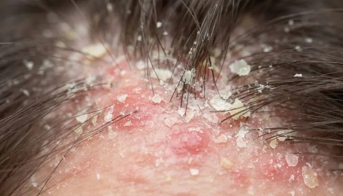 Close up of scalp irritation and dandruff flakes caused by Malassezia yeast