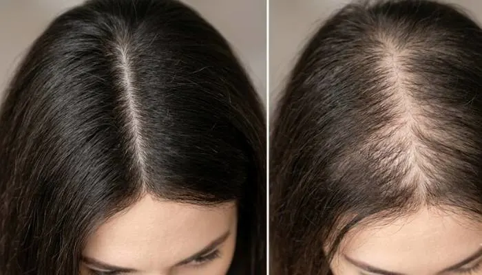 Close-up comparison graphic showing a normal hair parting versus a widening hair parting in women. Close-up comparison graphic showing a normal hair parting versus a widening hair parting in women.